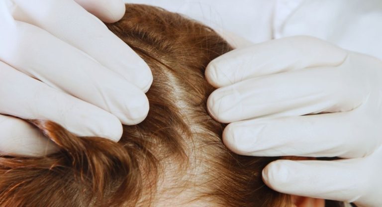 Mains gantées d'un médecin écartant les cheveux pour examiner le cuir chevelu d'une patiente