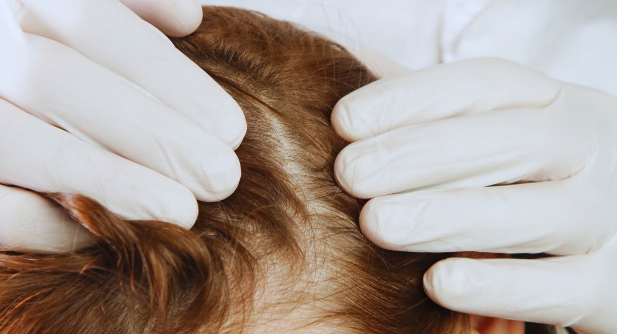 Mains gantées d'un médecin écartant les cheveux pour examiner le cuir chevelu d'une patiente